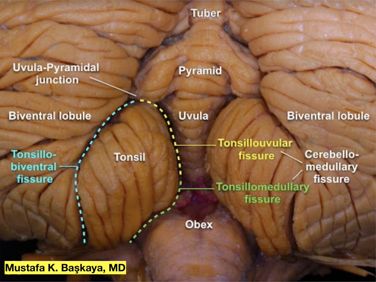 🧠Tonsillouvular fissure approach
👉direct route &amp; excellent surgical view to lesions around fourth ventricle, particularly dorsal &amp; lateral aspects
👉minimizes traversing normal cerebellar tissue
sciencedirect.com/science/articl…
#nsgy #MedTwitter #neurotwitter #neuroanatomy #microsurgery