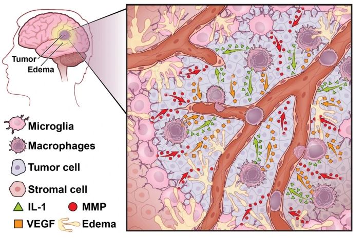 TheNeuroNetwork's tweet photo. Macrophages and microglia: the cerberus of glioblastoma

A new review published in Acta Neuropathologica Communications from @AliceBuonfi and @HambardzumyanL1 

https://t.co/AakvRSwQ35 https://t.co/5qCZe9GB7d