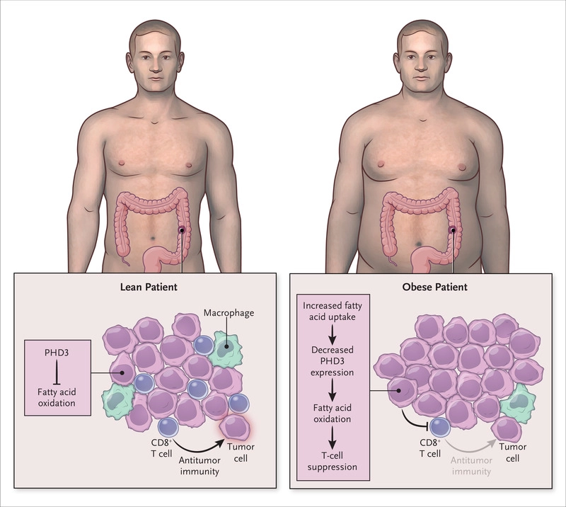 KimrynRathmell's tweet photo. Perspective on #Obesity #Immunity #Cancer by @JeffRathmell of #Rathmell^2 in @NEJM
https://t.co/RfgzworQSy
Great insights on a growing problem. https://t.co/fpTTlfocPm