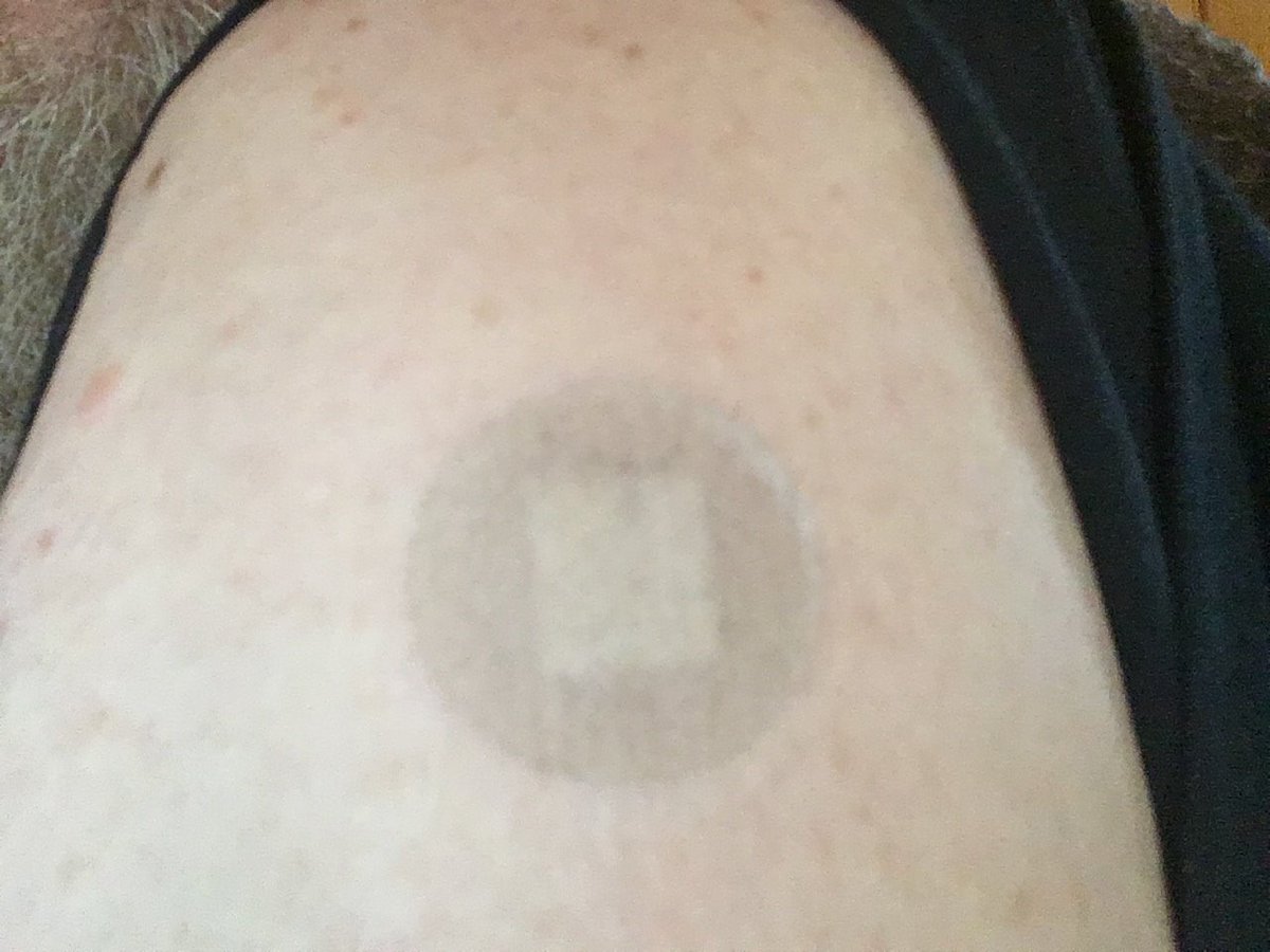 Here's the most critical question at this time: 
"Of the people presenting for their second dose of vaccine, how many will still have their Band-Aid from their first dose, still in place on their arm?" 
What do such results strongly suggest?