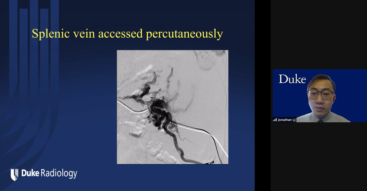 JonMartinMD's tweet photo. Happening now @DukeRadiology @DukeIR resident #JonathanLi presents a #ColemanCase #DukeRadiologyGrandRounds on the creation of a percutaneous retroperitoneal splenorenal shunt (PRESS) by portal wizard #PaulSuhocki https://t.co/lnPv5kDIf4