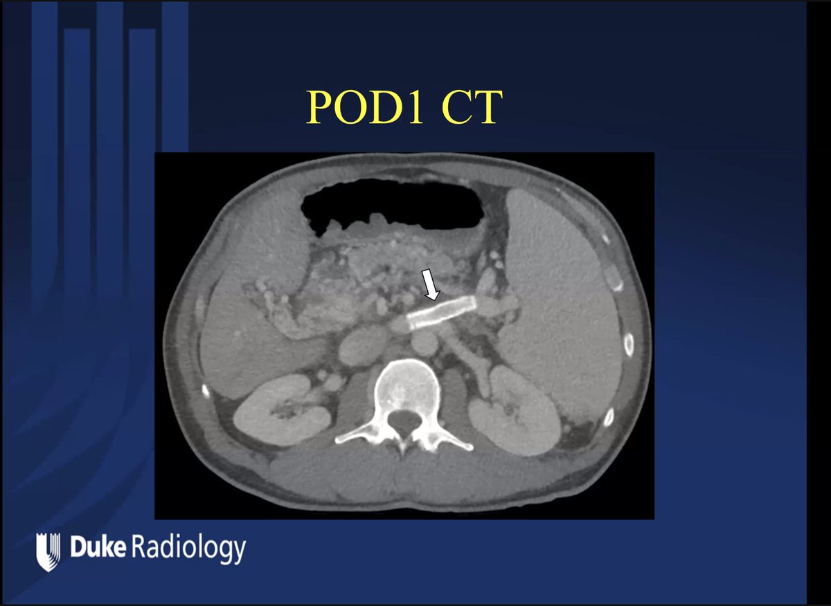 JonMartinMD's tweet photo. Happening now @DukeRadiology @DukeIR resident #JonathanLi presents a #ColemanCase #DukeRadiologyGrandRounds on the creation of a percutaneous retroperitoneal splenorenal shunt (PRESS) by portal wizard #PaulSuhocki https://t.co/lnPv5kDIf4