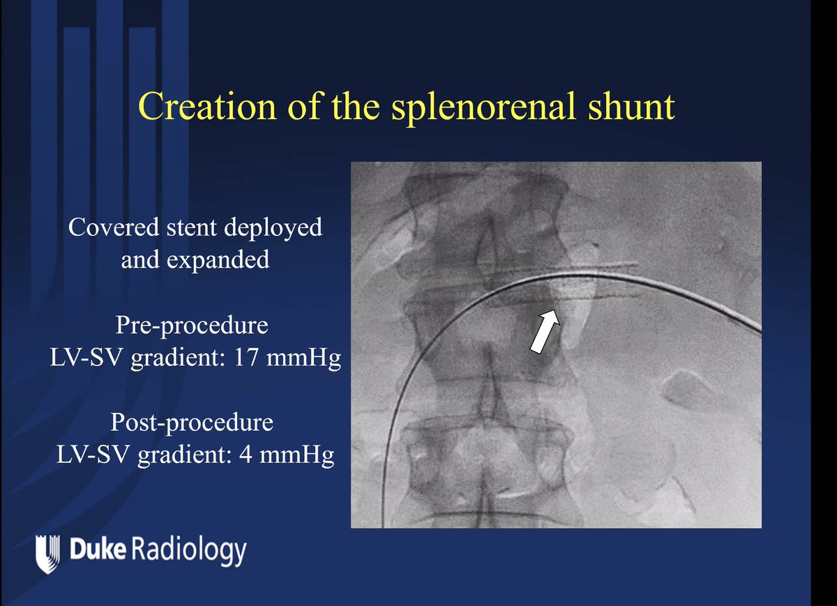 JonMartinMD's tweet photo. Happening now @DukeRadiology @DukeIR resident #JonathanLi presents a #ColemanCase #DukeRadiologyGrandRounds on the creation of a percutaneous retroperitoneal splenorenal shunt (PRESS) by portal wizard #PaulSuhocki https://t.co/lnPv5kDIf4