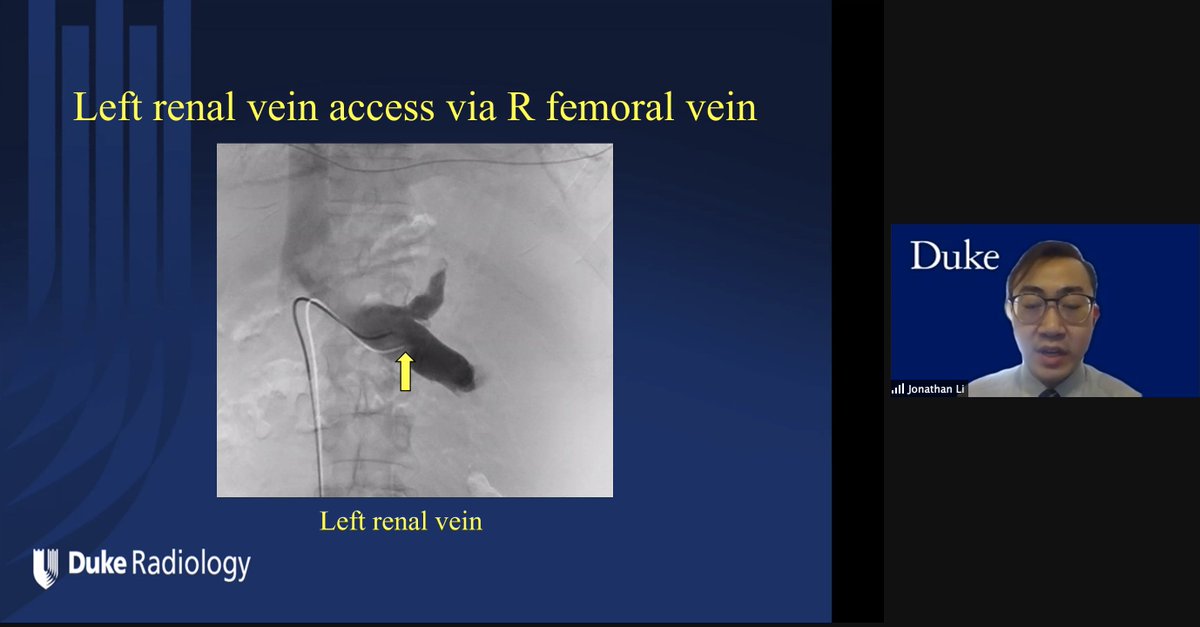 JonMartinMD's tweet photo. Happening now @DukeRadiology @DukeIR resident #JonathanLi presents a #ColemanCase #DukeRadiologyGrandRounds on the creation of a percutaneous retroperitoneal splenorenal shunt (PRESS) by portal wizard #PaulSuhocki https://t.co/lnPv5kDIf4