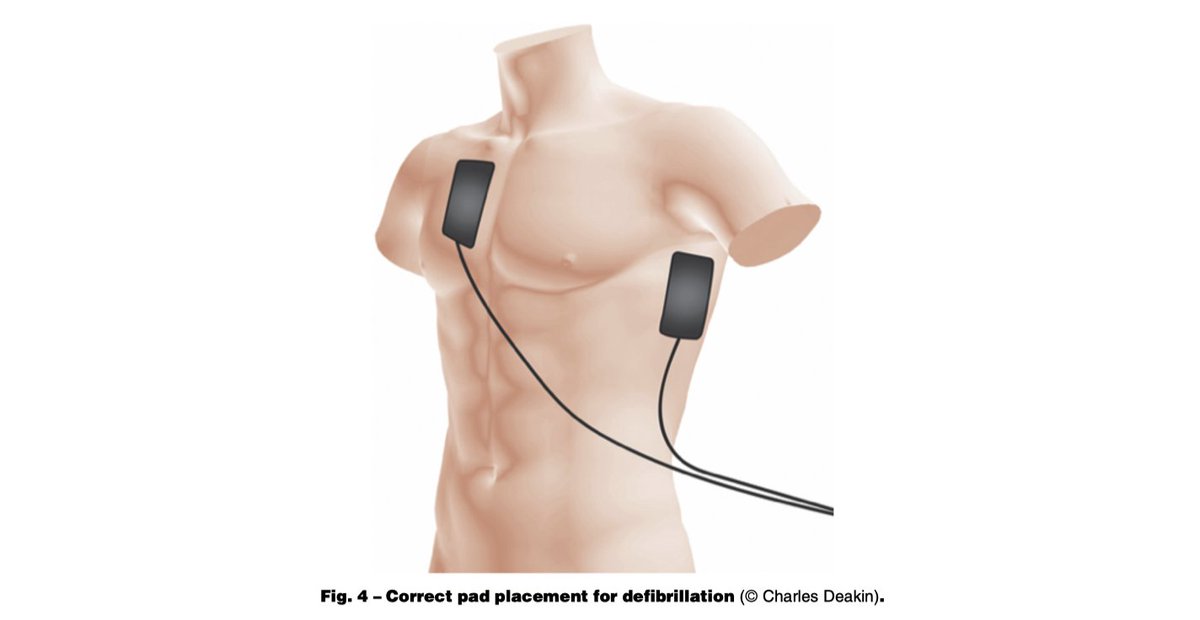 tscquizzato's tweet photo. This is the new illustration of ERC 2021 guidelines showing correct pad placement for defibrillation #RESUS21 https://t.co/gDBYTmoUUV
