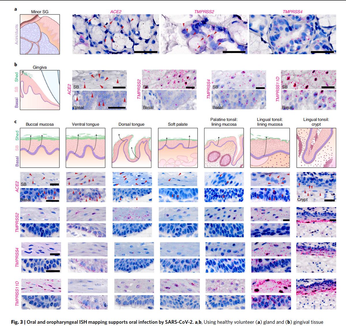 EricTopol's tweet photo. New @NatureMedicine 
"The oral cavity is an important site for SARS-CoV-2 infection and implicate saliva as a potential route of SARS-CoV-2 transmission."
https://t.co/UTfsc86XNP
Elegant work. Saliva from asymptomatic individuals transmitted covid ex vivo https://t.co/G9SeSIoKSB