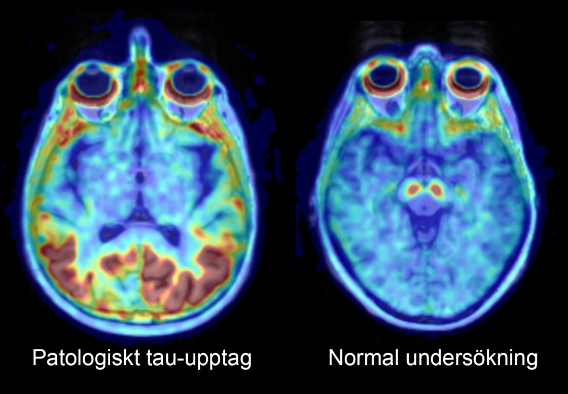 Alzheimers sjukdom tycks utvecklas snabbare hos kvinnor jämfört med män. Hos kvinnor ansamlas det sjukdomsalstrande proteinet tau fortare enligt en ny studie från det strategiska forskningsområdet MultiPark vid Lunds universitet.

Läs vidare: multipark.lu.se/sv/artikel/sna…