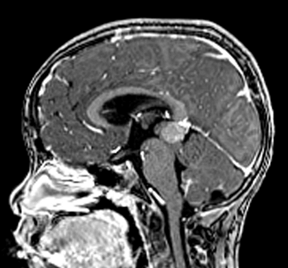 Applied_Rad's tweet photo. Learn about Pineoblastoma, a highly malignant form of #pinealglandtumors; is extremely aggressive, warranting a comprehensive work-up & therapy plan. Contrast-enhanced #MRI can diagnose this neoplasm and help guide disease management. https://t.co/1zgN2QhZWX @GuerbetGroup #CEMRI https://t.co/NuGh9L4YcW