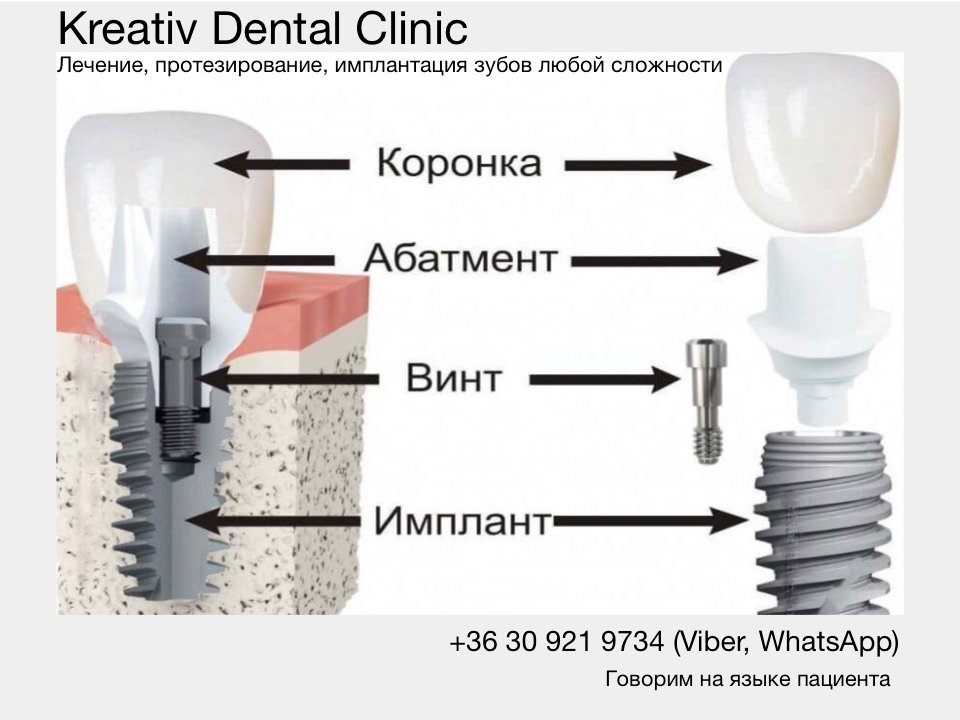 Импланты Osstem Томск Северо-Каштачный 1-й стоматология эталон отзывы томск