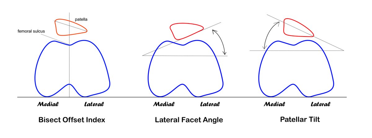 MassageFitMag's tweet photo. For decades, researchers have used different angles to identify patellar tracking disorder, but so far, there is no consensus of what is "normal" #kneetracking. #kneepain #kneesurgery #physicaltherapy
https://t.co/M8kF2YvtZv https://t.co/Nt3ZRgE1mT
