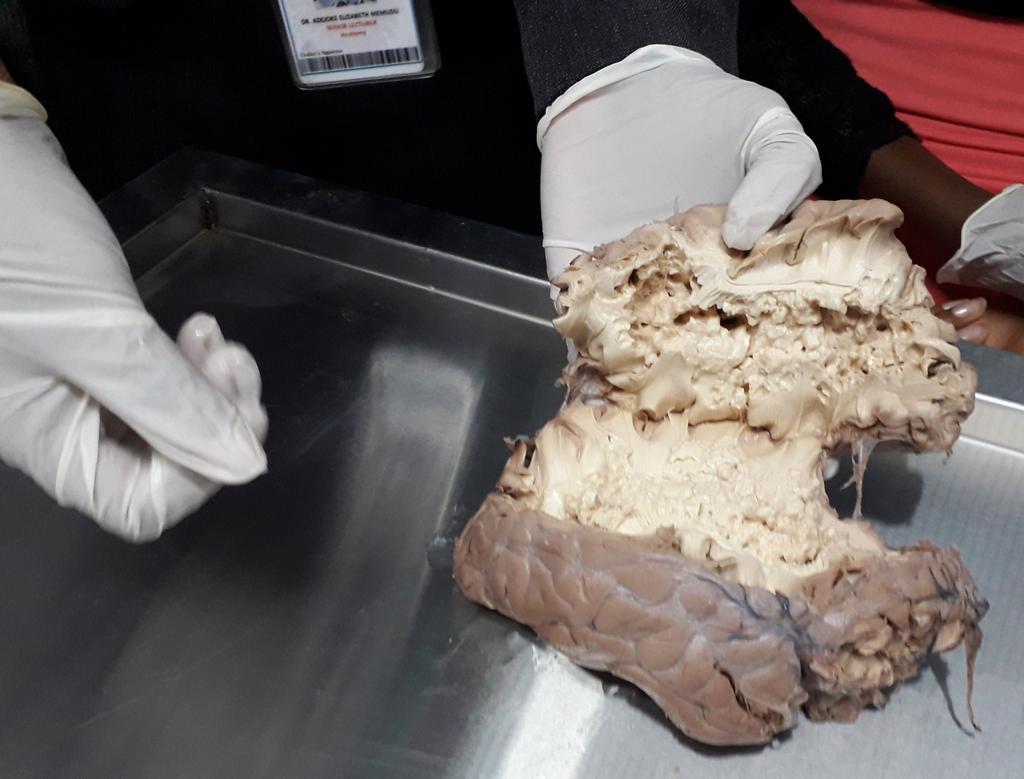 Lizzydrealme's tweet image. @blackinanatomy  Beautiful white mater components of the Brain highlights of collections of the brain tracts: corticospinal, corticobulbar ... ☺awesome 
#BrainAwarenessWeek2021 
@ibroSecretariat @Women_inNeuro @SfNtweets @anat_soc @TheBaleLab @Women_inNeuro