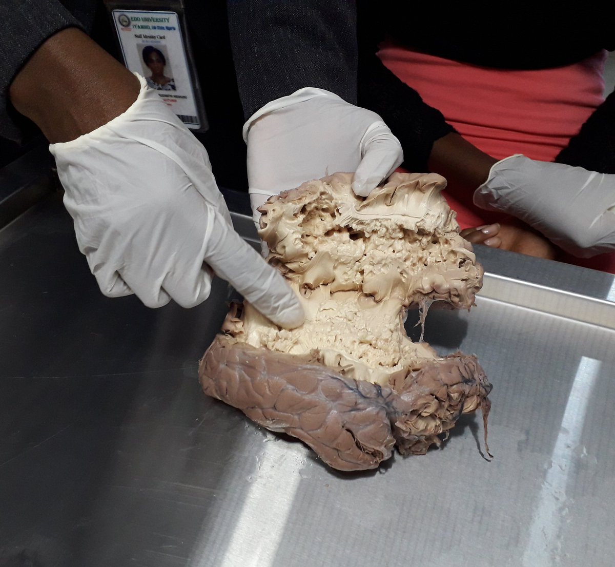 Lizzydrealme's tweet image. @blackinanatomy  Beautiful white mater components of the Brain highlights of collections of the brain tracts: corticospinal, corticobulbar ... ☺awesome 
#BrainAwarenessWeek2021 
@ibroSecretariat @Women_inNeuro @SfNtweets @anat_soc @TheBaleLab @Women_inNeuro