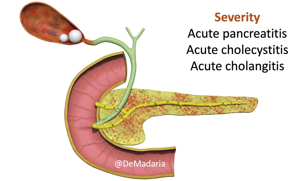 DeMadaria's tweet photo. Severity criteria for acute pancreatitis, acute cholecystitis and acute cholangitis #TheAmylaseSchool
#UEGambassador @my_ueg #HiloAEG @aegastro @gastromx @sage_gastro @almagoch @OPGEgastro @aecirujanos @SEEDendoscopia @lelecapurso @MarcBesselink https://t.co/V3inm7Q4gt