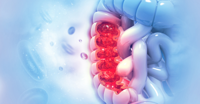 aldodoria's tweet photo. Over the past 20 years, we’ve seen #colon #cancer cases and deaths decline because of new and effective screening options like #colonoscopies and fecal DNA tests. It’s encouraging to see an increase in screenings for this very curable cancer. https://t.co/JvC8ve9G5J. https://t.co/L0W92YIAn8