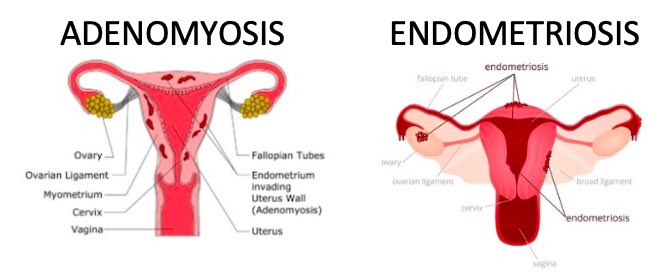 scotswarrior84's tweet photo. Do you know the many others illnesses which are linked to #Endometriosis. 

Some may also have #PCOS - Polycystic Ovarian Syndrome. 
Some may also have #Adenomyosis. 
Some may also have #PFD - Pelvic Floor Dysfunction/Disorder. 
Some may also have #Asthma. 

@endowestlothian https://t.co/5Ml9A6MGpp