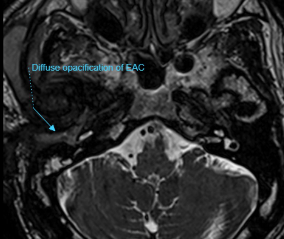 UMaryland Neuroradiology tweet media