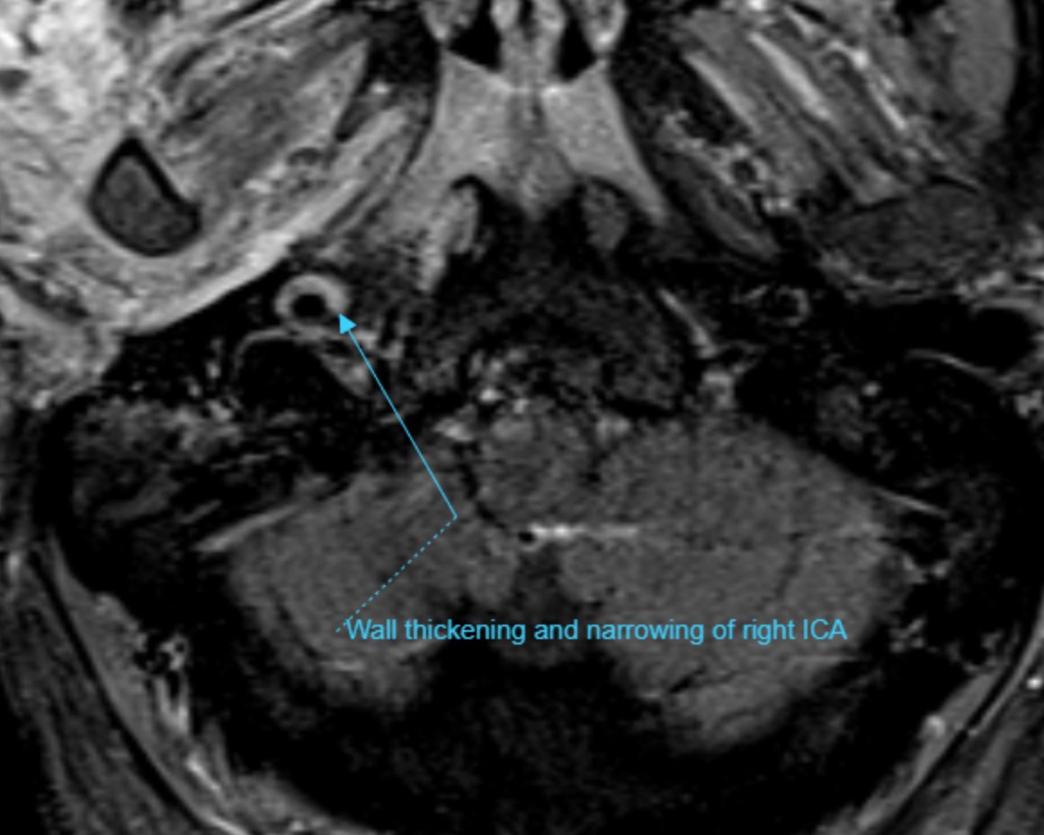 UMaryland Neuroradiology tweet media
