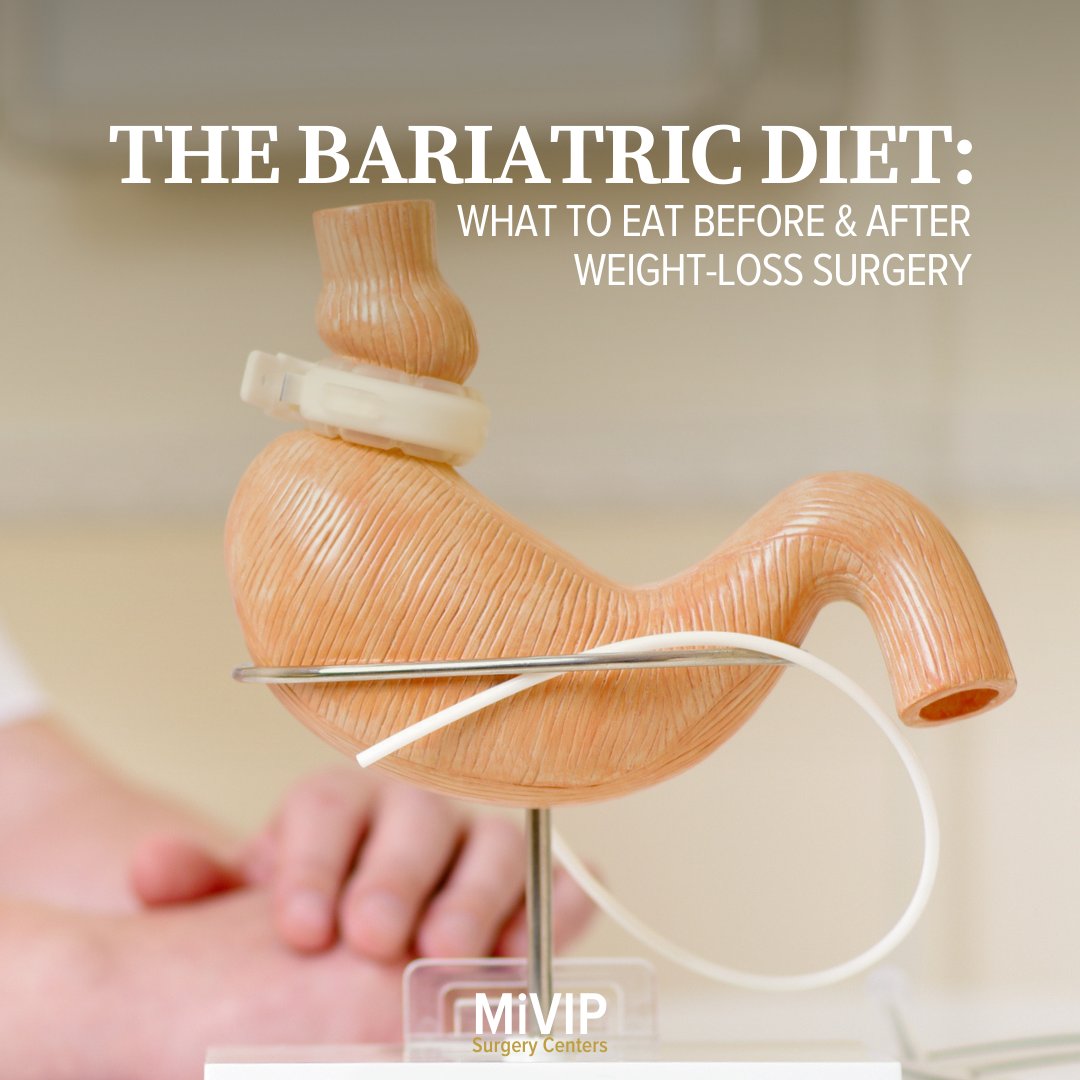 miVIPSurgery's tweet photo. Are you considering Bariatric procedures like #GastricSleeve and #GastricBypass? Read our blog post and find out:

→  What Patients Eat Before And After Surgery
→ What Foods You Should Not Eat Before And After Surgery

🔗 Full blog post: https://t.co/T43kL9U02U https://t.co/XF0bn7gSUR