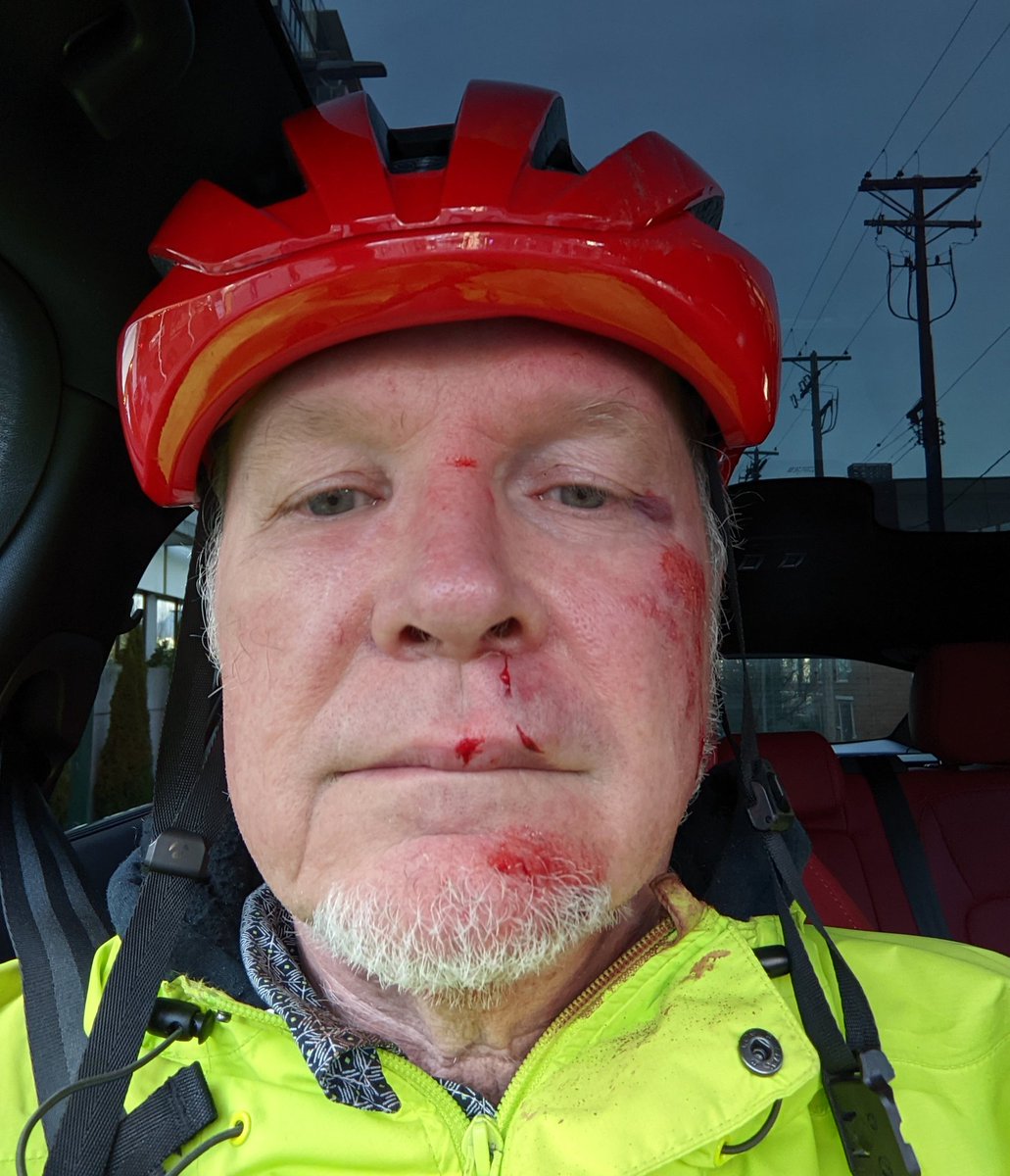 The author after a cycling accident, pictured wearing the helmet that probably saved his life.