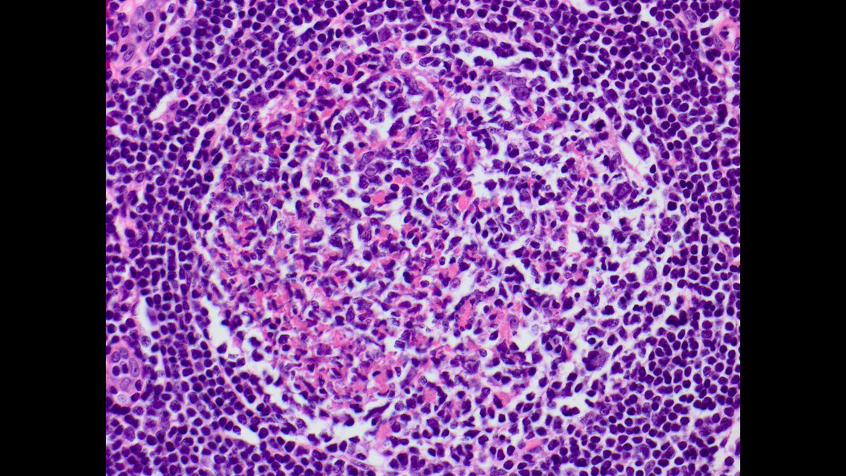 judith_ferry's tweet photo. Pathologists! Here is a small mesenteric lymph node removed with a bowel DLBCL. Node has intact architecture but some germinal centers are monotonous &amp; partly or mostly replaced by intensely BCL2+ cells. In situ follicular neoplasia! Clonally related to the DLBCL. #hemepath https://t.co/TDnaJiso6c