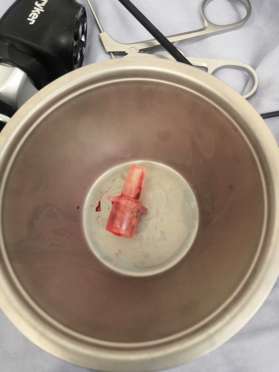 tms_tom's tweet photo. Hallazgo: Conector de tubo endotraqueal
Anteced: Colecistectomía laparoscopica 7 meses previos

Como llegó a ese lugar? Tal vez nunca lo sabremos
@educanestesia @MonaresTI @OmarS_V @job_rdz @jorgedorantesMD @memoruizv https://t.co/JSqEIXYgej