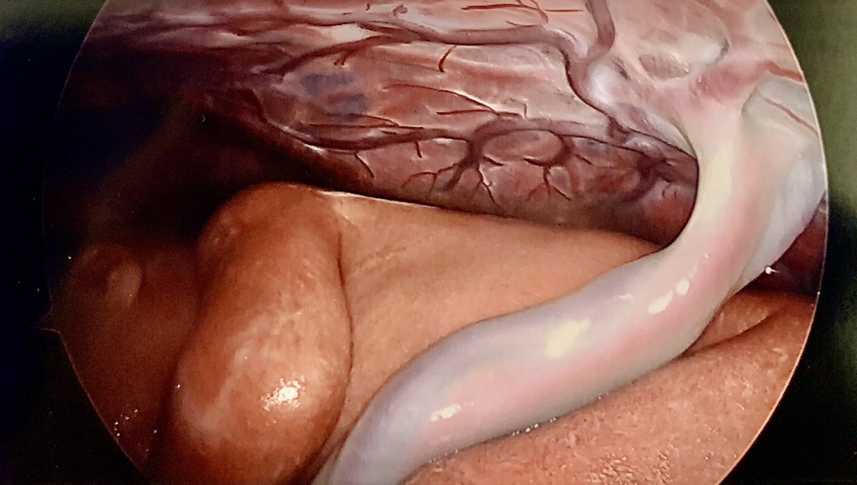 Fetus in the womb. #fetalsurgery