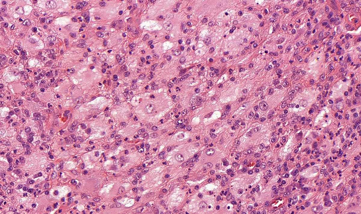Skin, Adult

#Dermpath #Hemepath #BSTpath #Pathtwitter
