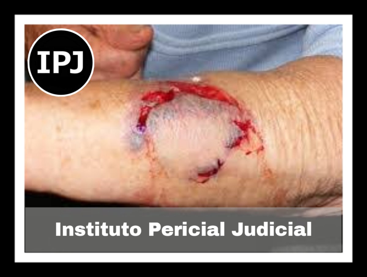 IPJ_OFICIAL's tweet photo. ⚫¿Sabías qué?... 
Una herida contusa es la pérdida de la continuidad de la piel, que se produce por traumatismo con un objeto romo (no cortante), y, por tanto, tiene un componente de herida y otro de contusión. ⚫

#Somos_IPJ
#IPJColbach https://t.co/OfYdu7KQ7b