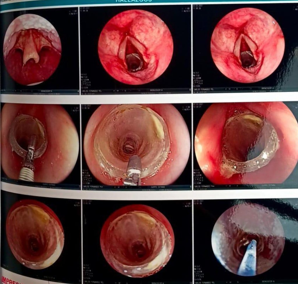 tms_tom's tweet photo. Hombre 46a. Sin APP. Para retiro de cuerpo extraño en vía aérea de 7 meses de evolución. Diagnosticado 1 mes previo (disfonia y disnea leve a moderada) son obstrucción de vía aérea. @memoruizv @AnestesiaR @educanestesia @Dr_Dive https://t.co/i83XNKdoi5