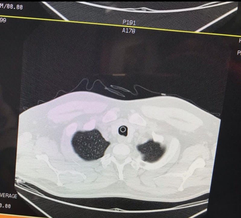tms_tom's tweet photo. Hombre 46a. Sin APP. Para retiro de cuerpo extraño en vía aérea de 7 meses de evolución. Diagnosticado 1 mes previo (disfonia y disnea leve a moderada) son obstrucción de vía aérea. @memoruizv @AnestesiaR @educanestesia @Dr_Dive https://t.co/i83XNKdoi5