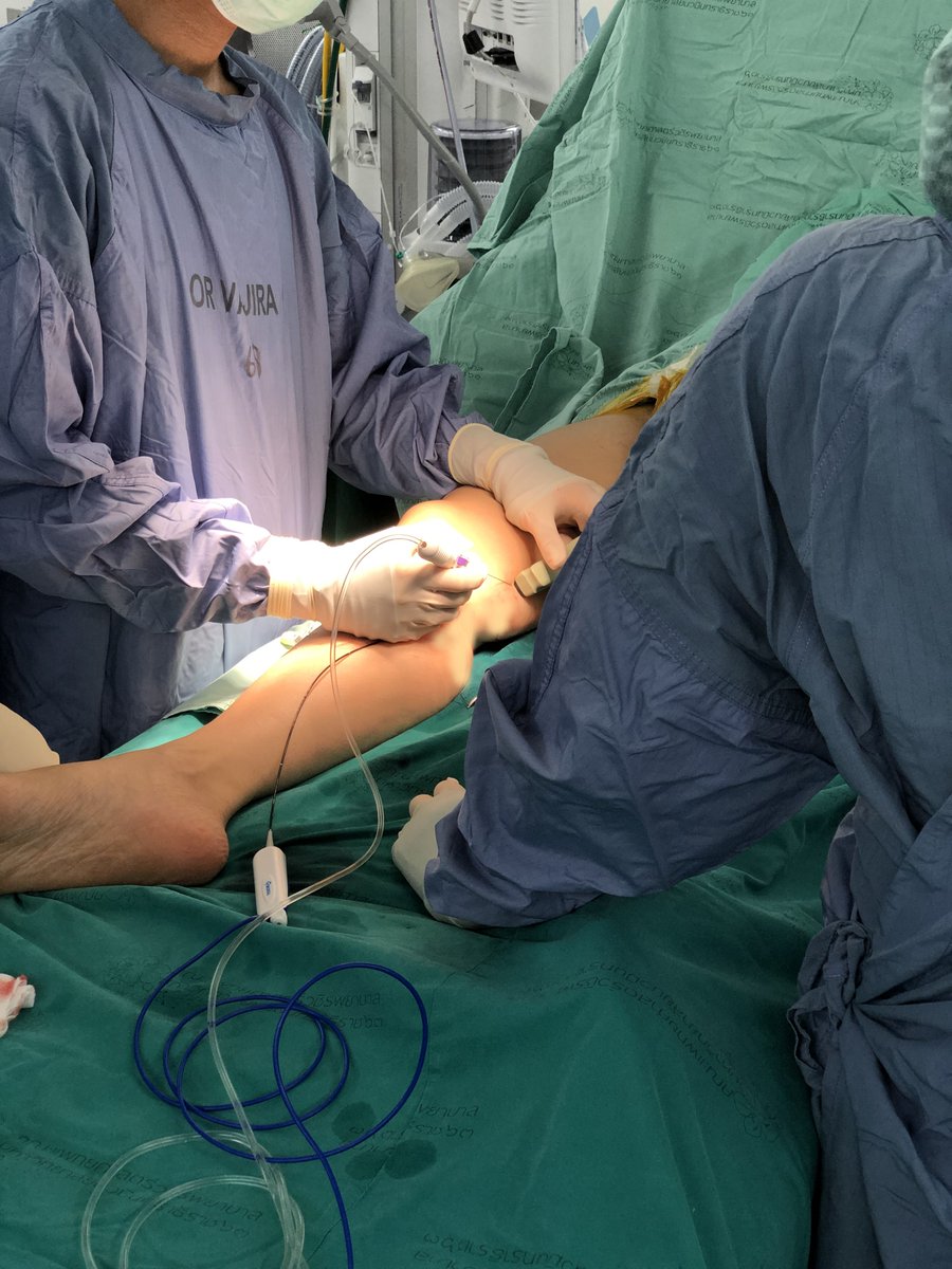 Dr. Watcharapong Pitaksantayothin successfully treated a patient suffering from varicose veins using @RfMedical Endovenous Radiofrequency Ablation (#RFA) System. The procedure was conducted at Vajira Hospital in #Bangkok, #Thailand. The patient is doing very well post-procedure.