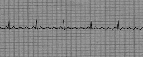 njohnstone10's tweet photo. Time to practice those #ECG interpretation skills! 

What ECG pattern does this image most closely depict? 

Try the poll below and check back tomorrow for the answer! #biom4180 https://t.co/RlaxhmfuNY