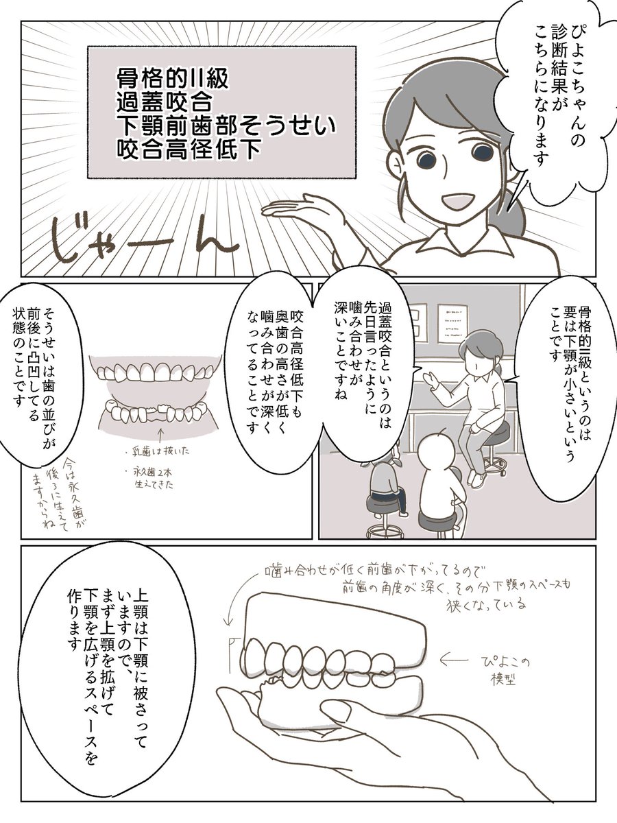 子供の歯科矯正漫画③
検査結果と上顎の治療開始について。
記憶を辿って書きましたが説明間違ってたらすみません…
#育児漫画 #育児絵日記 #小児歯科矯正 #歯科矯正