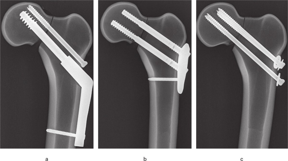 BoneJointRes's tweet photo. This study evaluated the biomechanical performance of a locking plate system with spring-loaded telescoping screws in cyclic compressive loading in comparison to two widely accepted gold standard treatment methods for unstable femoral neck #fracture https://t.co/nUuCuNH1ah #ortho https://t.co/5L5i25YjzK