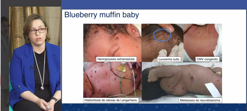Blueberry muffin baby. De obligada biopsia, en #Dermopediatrics.