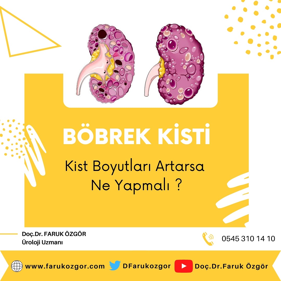 DFarukozgor's tweet photo. Böbrek kistlerin çoğu tedavi gerektirmesede📌

 BOYUTLARININ artmasından ya da KANSERE dönüşmesinden dolayı cerrahiye ihtiyaç duyulan böbrek kistleri ile karşılaşabiliyoruz❗❗❗ https://t.co/C4ScJ1r37n