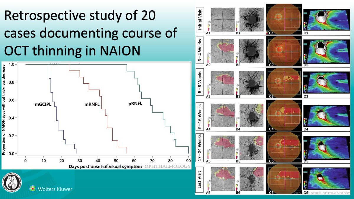 Patterns of #Retinal #Ganglion Cell Damage in #NAION Assessed by Swept-Source Optical Coherence Tomography: JNO
Article: bit.ly/2Qwl5pE
#brain #eye #vision #research #neuro #neurology #ophthalmology #ophtho #NeuroOphth #EyeStroke #OpticNeuropathy #OCT