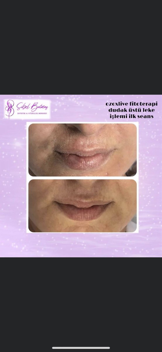 🌸Ozon cilt bakım uygulamasında, ozon gazı kullanılarak cildin yenilenmesi ve daha pürüzsüz görünmesi amaçlanıyor. 
☎️0541 259 77 31
#sakarya #sakaryaozonterapi  #sakaryaozonbakım  #sakaryaozonfitoterapi #ozon #sakarya #ciltbakımı #bölgesel #lazer 
#sakarya #sakaryaozonterapi