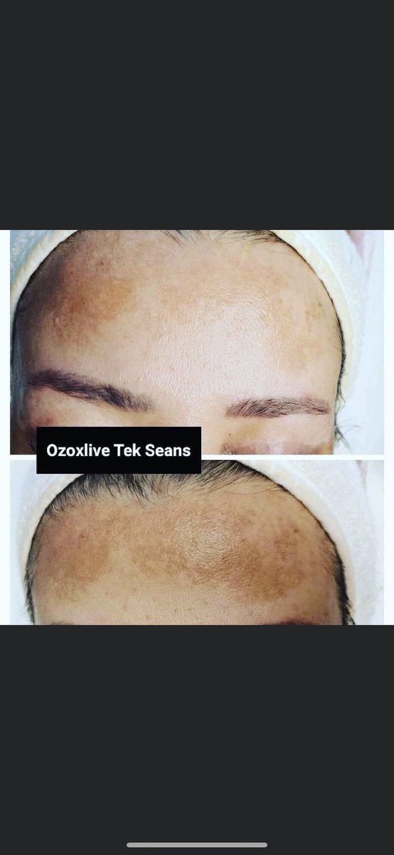 Ozoxlive leke çalışması ikinci seans🌸
☎️0541 259 77 31
#sakarya  #sakaryaciltbakımı  #sakaryaleketedavisi  #sakaryaciltgençleştirme  #sakaryaciltbakımıkampanya  #sakaryadermapen  #sakaryahydrafacial  #sakaryagüzellikmerkezi  #sakaryagüzelliksalonu  #sakaryaçark  #sakaryaserdivan