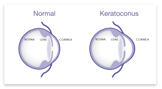 htxeye's tweet photo. Keratoconus is an eye condition in which the cornea becomes thin and develops a cone-shaped bulge. When the cornea is not shaped correctly, light rays will not hit the retina correctly, resulting in poor vision.  
https://t.co/jPLtvtcXjz
⁠
#keratoconus #MD #opthalmologist https://t.co/qcRHvrqKR9