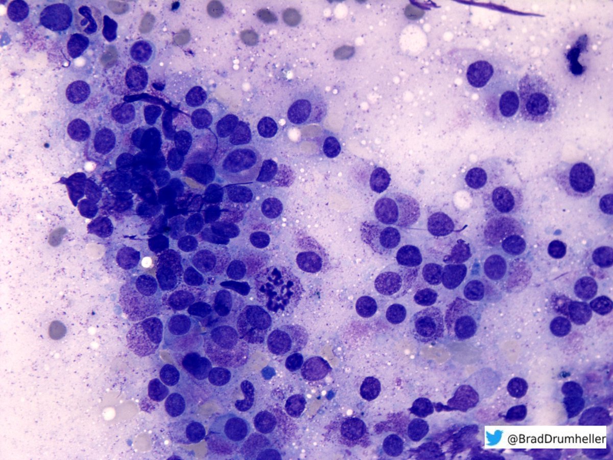 PennHemePath's tweet photo. 63 year old male presenting with B symptoms and rapid progression to multi-system organ failure. 

WBC 12.8
Hb 10.1
PLT 14
76% neut
15% lymph
5% mono
2% myelo
2% metamyelo

A BM biopsy is performed.
What stains would you order?
Diagnosis on morphology?
#hemepath #PathTwitter https://t.co/wNofE16I5Z