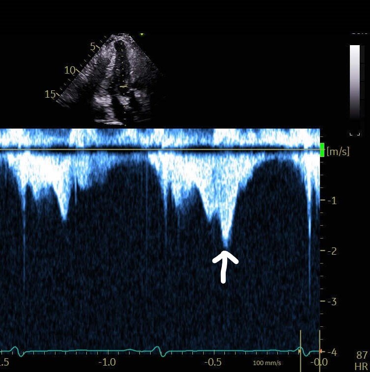 argulian's tweet photo. CW thru the aortic valve. What explains the flow marked by the arrow? https://t.co/uJGpO0lSzN