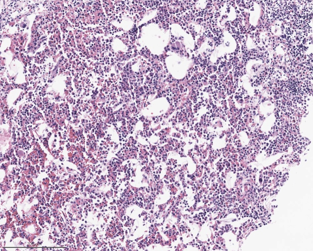 #FNAFriday Madness! Male pt. retroperitoneal mass, with suspicion for liposarcoma. But, but, why do we see megakaryocytes? EMH? Final dx: 

Myelolipoma! 

🔬Islands of hematopoietic cells and mature fat

🔬Usually show normal trilineage hematopoiesis

#pathtwitter #cytopath
