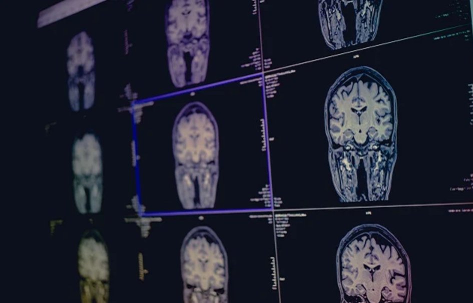 Scientists have identified new genetic clues in people who’ve had ‘silent’ strokes that are difficult to treat and a major cause of vascular dementia bit.ly/3d8dyFk