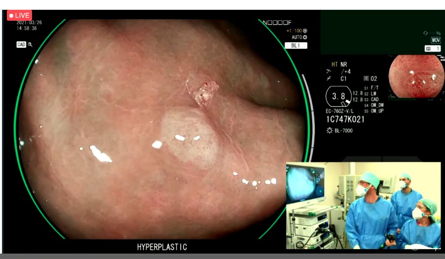 drmanmeetm's tweet photo. Missing real #live endoscopy but this is pretty close @ESGE_news #ESGEDays2021very slick.
#Polyp surveillance with CAD system and LCI images. Would add in an #endocuff to sweep behind folds and increase #ADR. https://t.co/uvOi6zxoaU