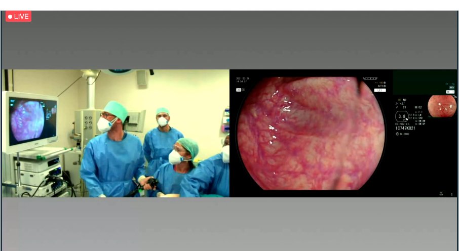 drmanmeetm's tweet photo. Missing real #live endoscopy but this is pretty close @ESGE_news #ESGEDays2021very slick.
#Polyp surveillance with CAD system and LCI images. Would add in an #endocuff to sweep behind folds and increase #ADR. https://t.co/uvOi6zxoaU