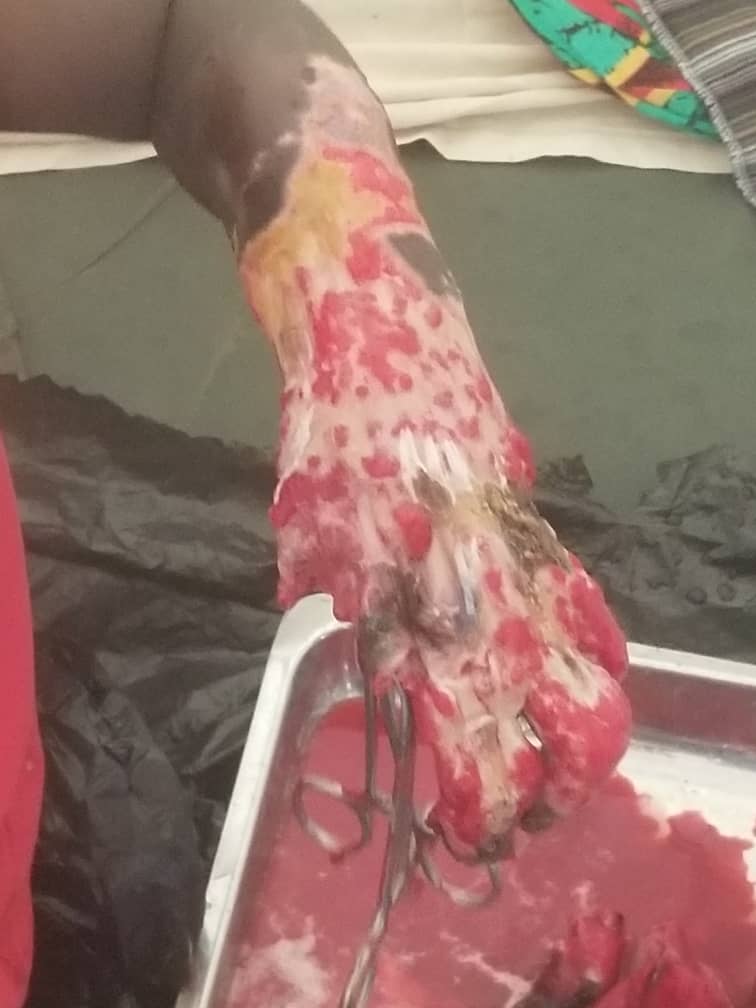 PapeSaliouSy2's tweet photo. TRES URGENT🛑🛑🛑🛑🛑⛔⛔
Cet enfant sur la photo s'appelle SADIO DIALLO , il doit subir une opération en URGENCE à l'hôpital des enfants de Diamniadio. Il a besoin de 107.500frs Pour AMPUTATION + 97.000frs ORDONNANCE. 
OM et WAVE AU 772874564.
PAYPALL👇
https://t.co/HQOE9Gn4Bl https://t.co/EO0MtpU1zh
