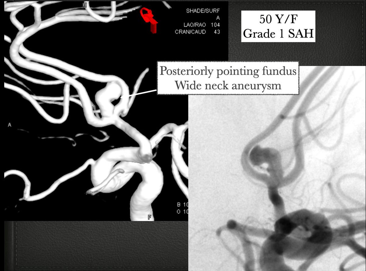 RashmiSaraf6's tweet photo. Wide neck aneurysms with posteriorly pointing fundus. Challenges with intrasaccular flow disruption devices like WEB. As Aneurysm height axis to parent artery angle becomes more acute,  meticulous planning makes them “Webbable”. # WEB #Microvention# intrasaccular aneurysm therapy https://t.co/1CjLxE82Av