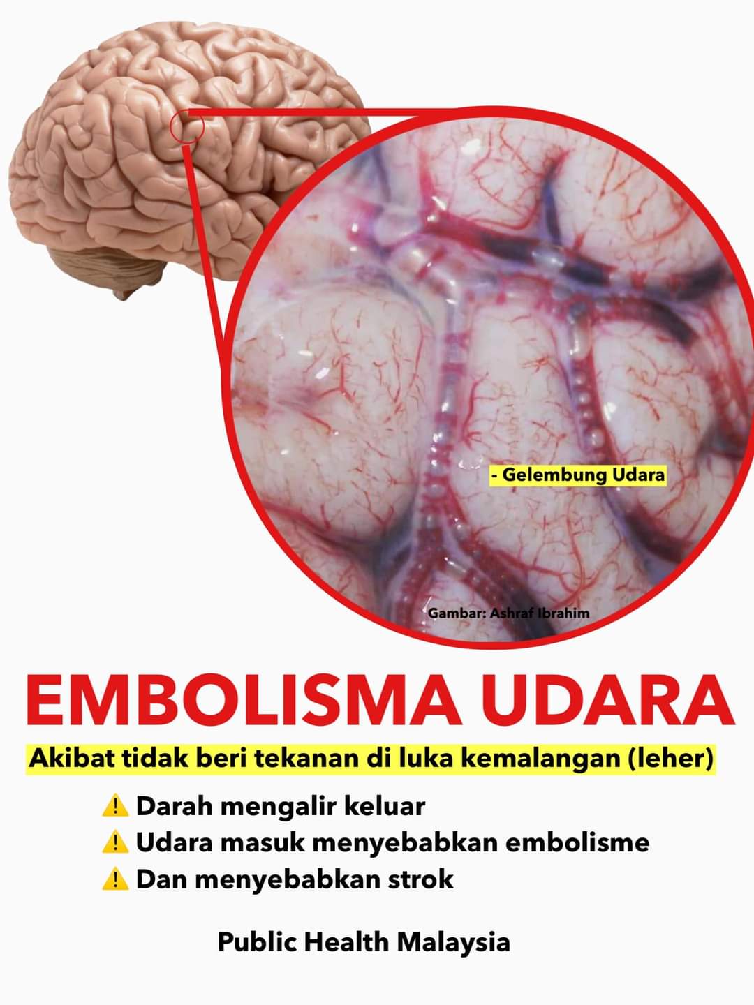 Public Health Malaysia On Twitter Akibat Tidak Tekan Luka Udara Masuk Ke Dalam Salur Darah Dan Naik Ke Atas Otak Seorang Remaja Telah Terlibat Di Dalam Kemalangan Jalan Raya Beliau Hanya Cedera