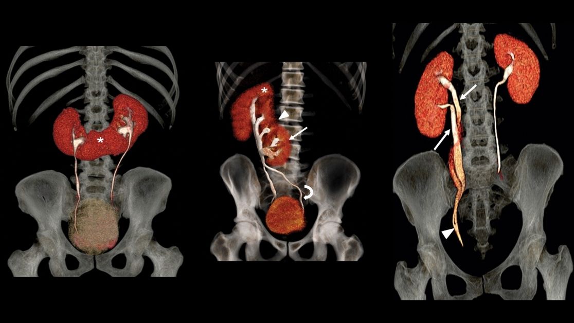 Congenital anomalies of kidneys &amp; ureters range from simple variants with no clinical significance to complex anomalies that may lead to end-stage renal disease. Learn the embryology, imaging findings &amp; clinical manifestations of anomalies. bit.ly/3cUNNYZ #RadRes #GURad
